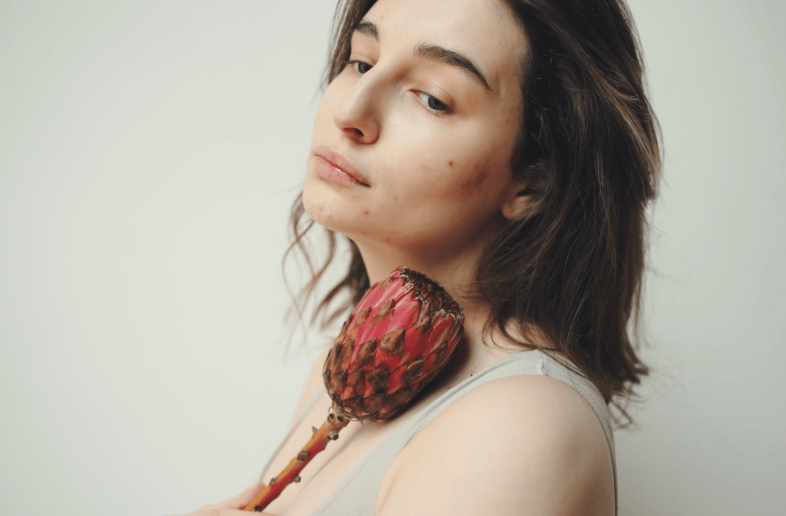Acné digestive : L'impact de l'alimentation sur notre peau et comment retrouver une peau saine de l'intérieur