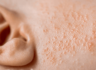 Acné du nourrisson : Comprendre et gérer les boutons sur la peau délicate de votre bébé