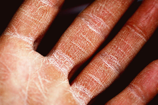 La routine idéale pour les peaux avec eczéma
